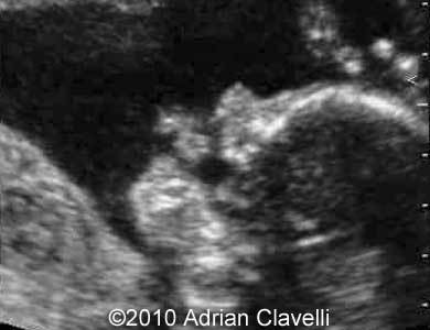 Midline_cleft_Clavelli_1