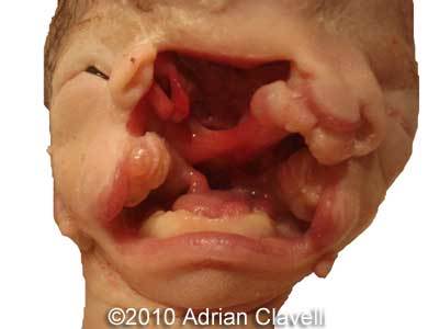 Midline_cleft_Clavelli_10