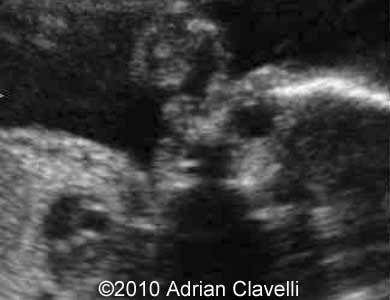 Midline_cleft_Clavelli_2