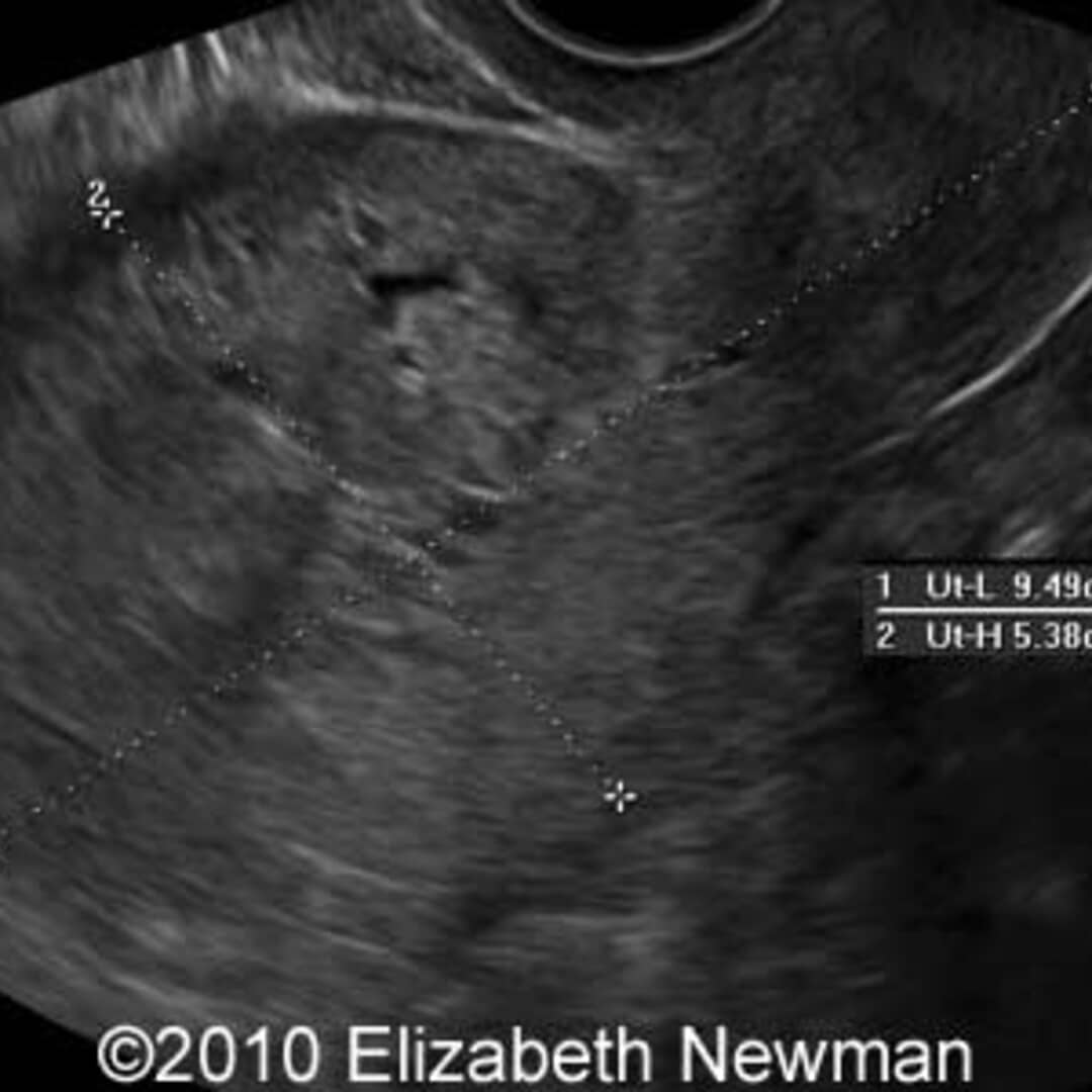 📃 Complete molar pregnancy