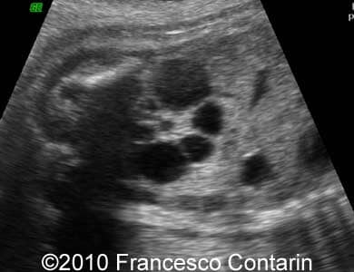 Multicyst_kidney_contarin_2