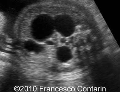 Multicyst_kidney_contarin_3