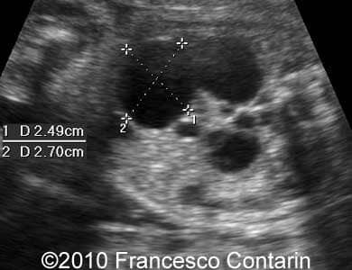 Multicyst_kidney_contarin_4