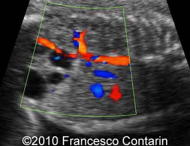 Multicyst_kidney_contarin_6