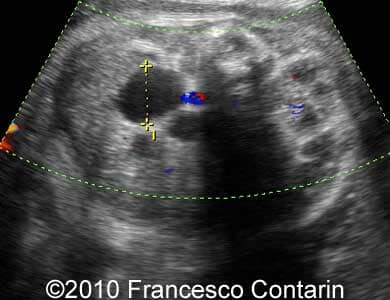 Multicystic_kidney_contarin