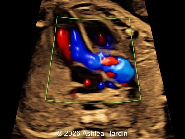 Left ventricular outflow tract 