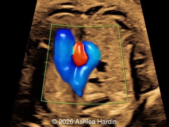 Three-vessel-trachea view