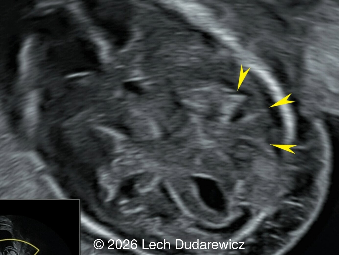 The yellow arrows indicate abnormal radial echogenic sulci in the temporal regions.