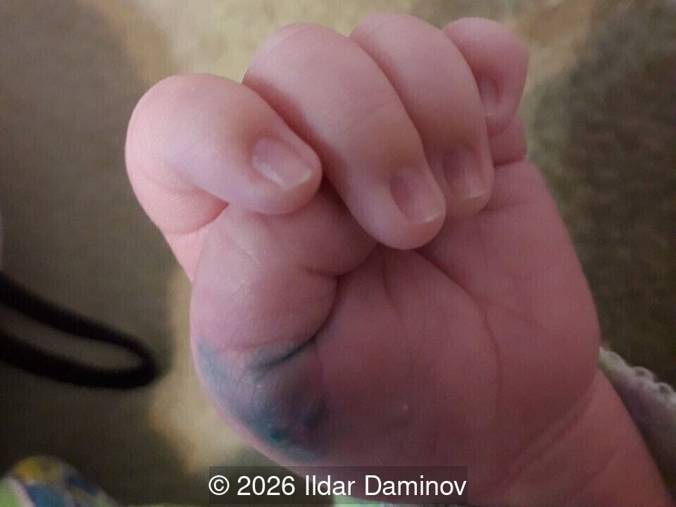 Clinical appearance of the infant's left hand following successful excision of the necrotic extra digit. 