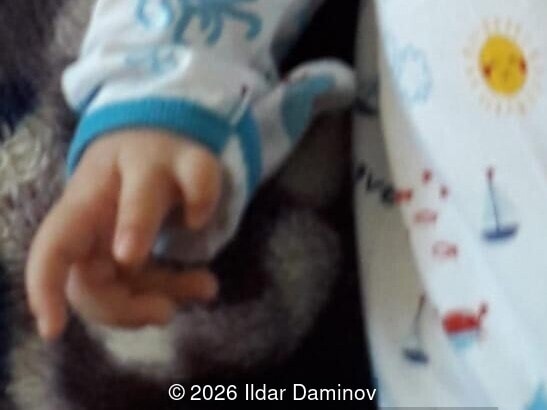 Postnatal appearance of the infant's right hand, demonstrating the isolated, intact preaxial polydactyly before its subsequent surgical intervention.