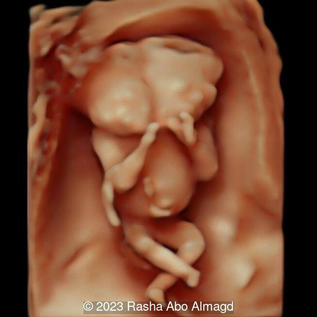 3D image demonstrating Diprosopus Conjoined twin