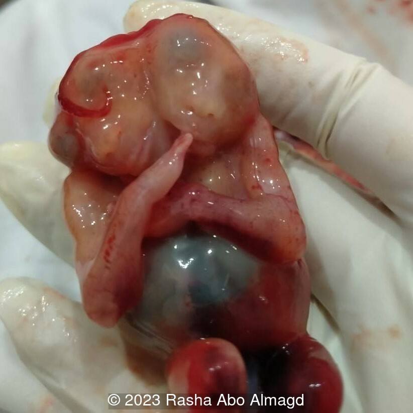 Post abortive image showing anterior view