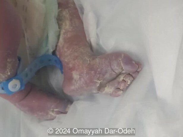 Postaxial polydactyly in foot