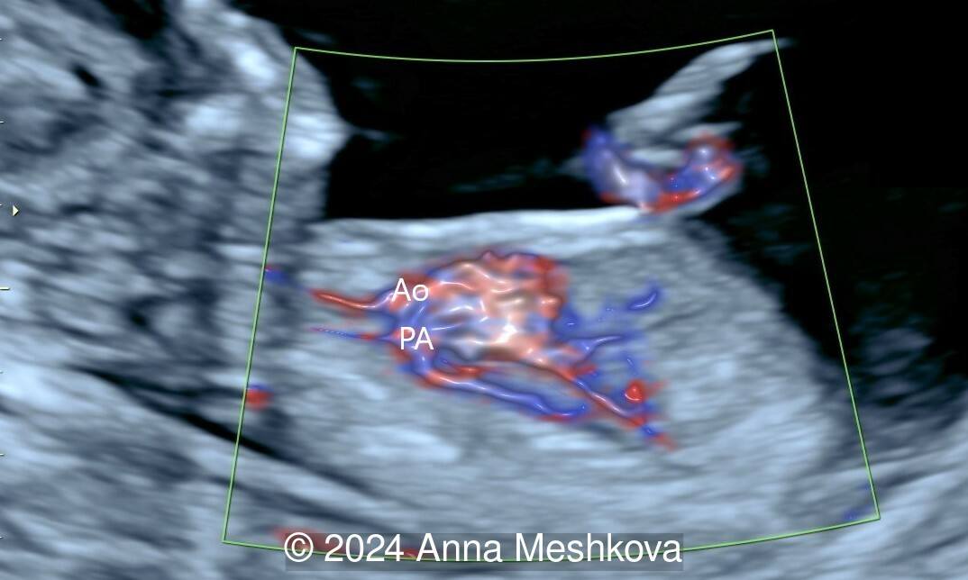 Ao: Aorta; PA pulmonary artery
