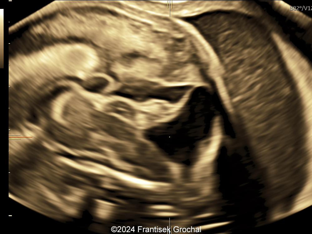 Upward-rotated hypoplastic cerebellar vermis with cystic structure within posterior fossa, and high insertion of the tentorium