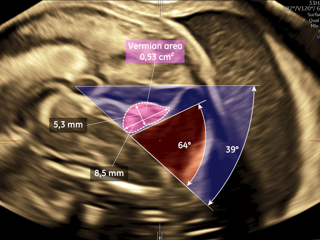 Upward-rotated hypoplastic cerebellar vermis (brainstem-vermis angle 64,45&deg;,craniocaudal vermian diameter 5,3 mm, anteroposterior vermian diameter 8,5 mm)