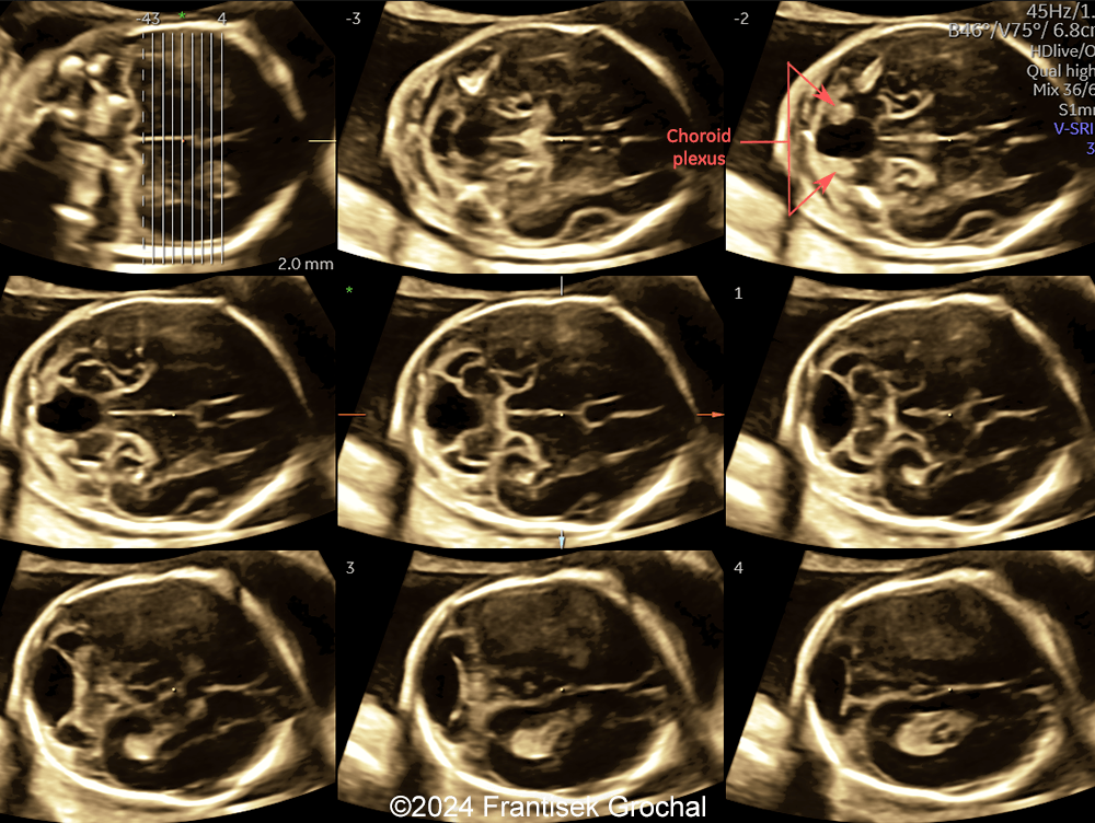 Transverse scans showing cystic structure within posterior fossa with inferolateral location of the fourth-ventricle choroid plexus outside the cyst.