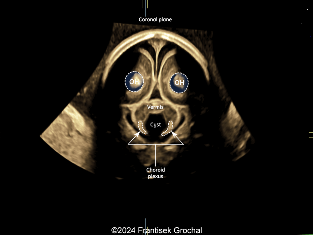 Coronal 3D view showing cystic structure within posterior fossa with inferolateral location of the fourth-ventricle choroid plexus outside the cyst.