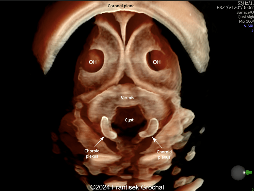 Coronal 3D view showing cystic structure within posterior fossa with inferolateral location of the fourth-ventricle choroid plexus outside the cyst.