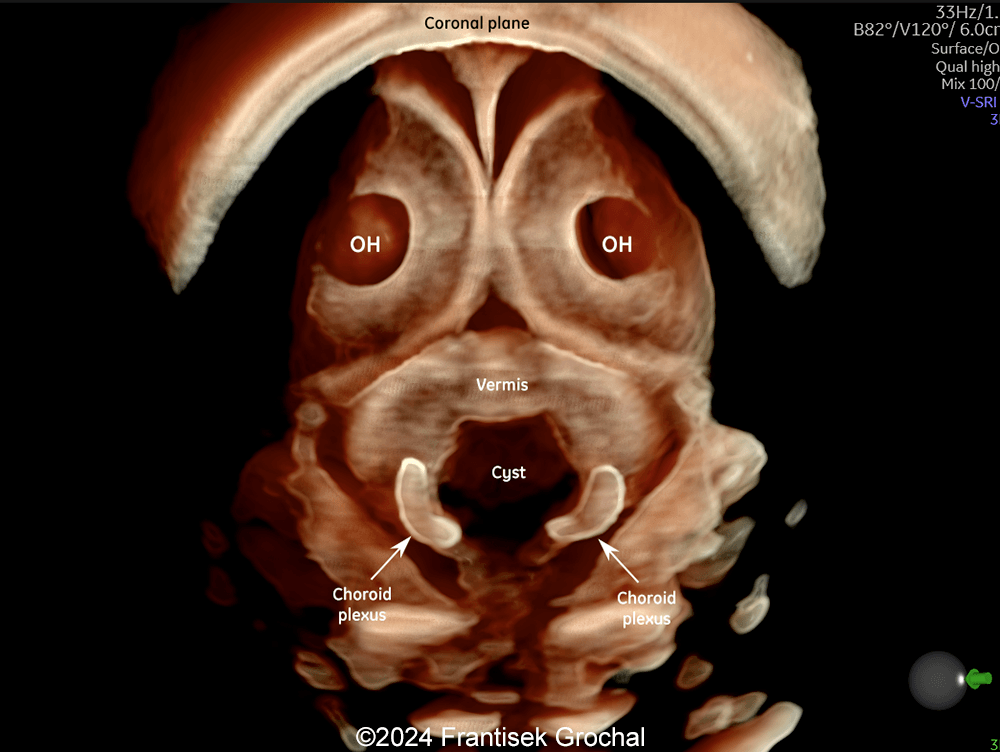 Coronal 3D view showing cystic structure within posterior fossa with inferolateral location of the fourth-ventricle choroid plexus outside the cyst.