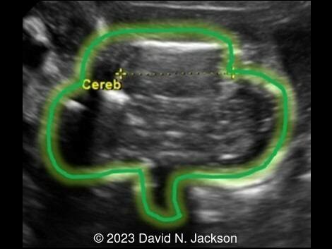 Ultrasound image demonstrates abnormal cloverleaf shape of the head.