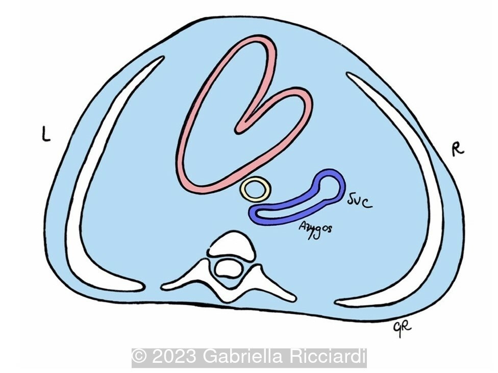 Schematic drawing demonstrating the azygos vein draining into the superior vena cava (SVC).