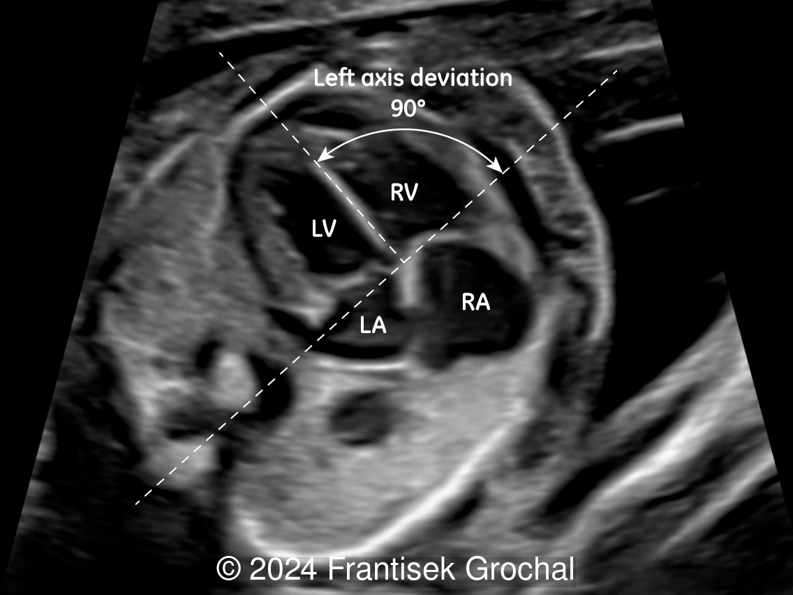 Four-chamber-view of the heart with left axis deviation (RV: right ventricle, LV: left ventricle, LA: left atrium, RA: right atrium).