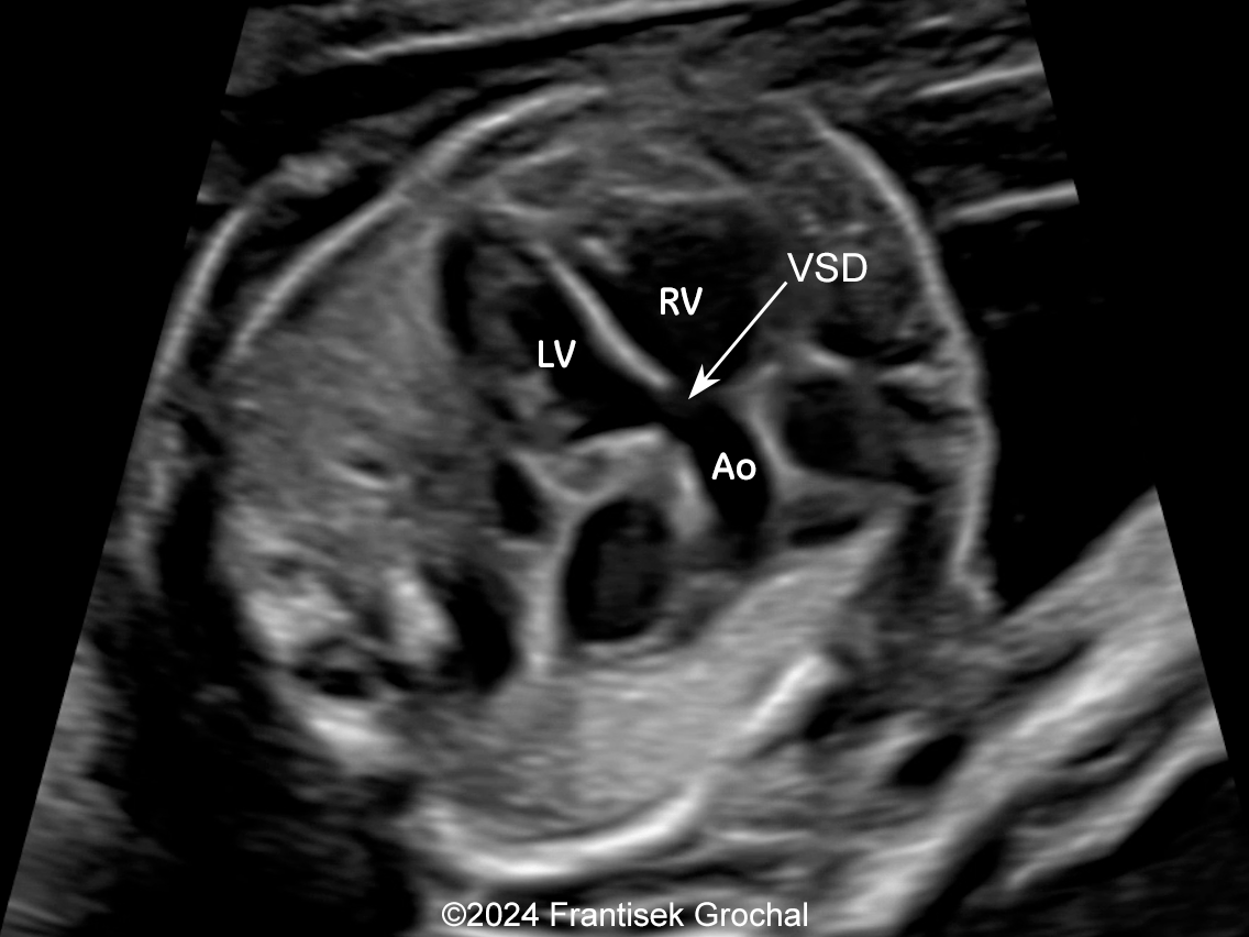 Ventricular septal defect with overriding aorta (LV: left ventricle, RV: right ventricle, Ao: aorta, VSD: ventricular septal defect).