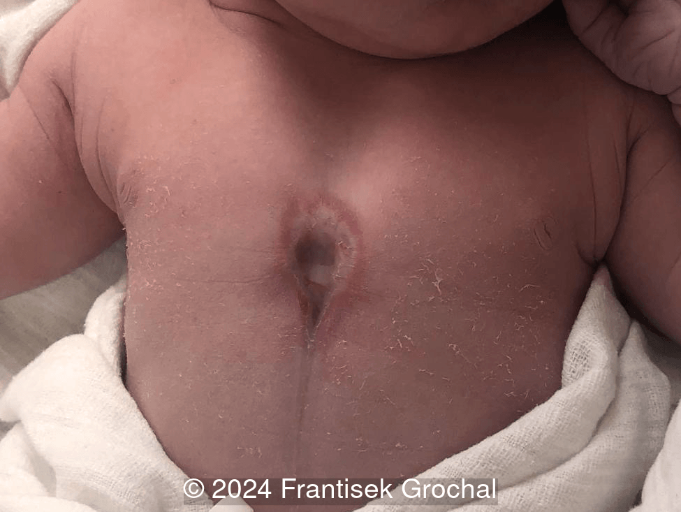 Postnatal image showing the sternal defect.