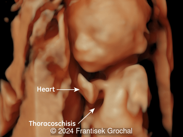 3-Dimensional reconstruction of sternal defect with ectopia cordis.