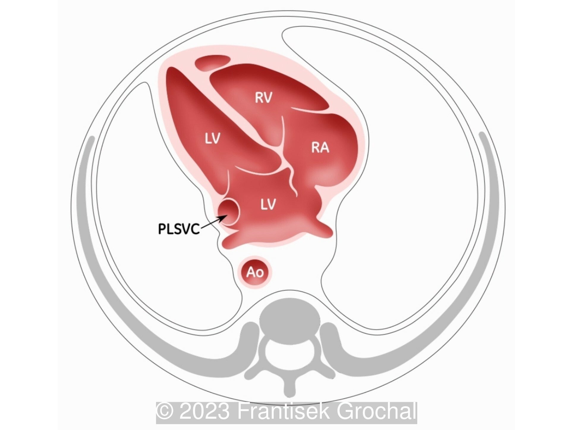 Schematic drawing of the four-chamber view showing the LSVC in cross section at the border of the left atrium.