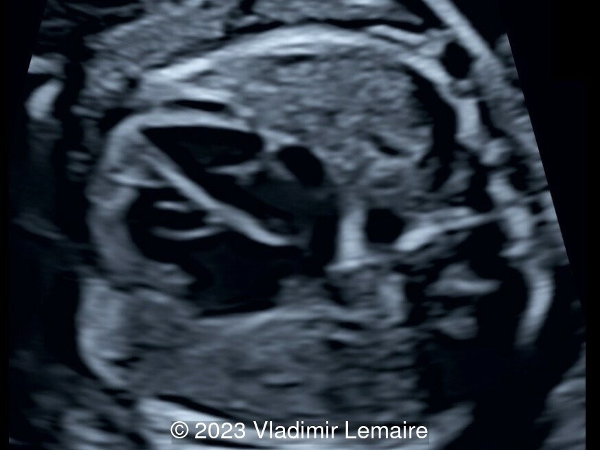 Corresponding ultrasound image at 22 weeks of gestation.