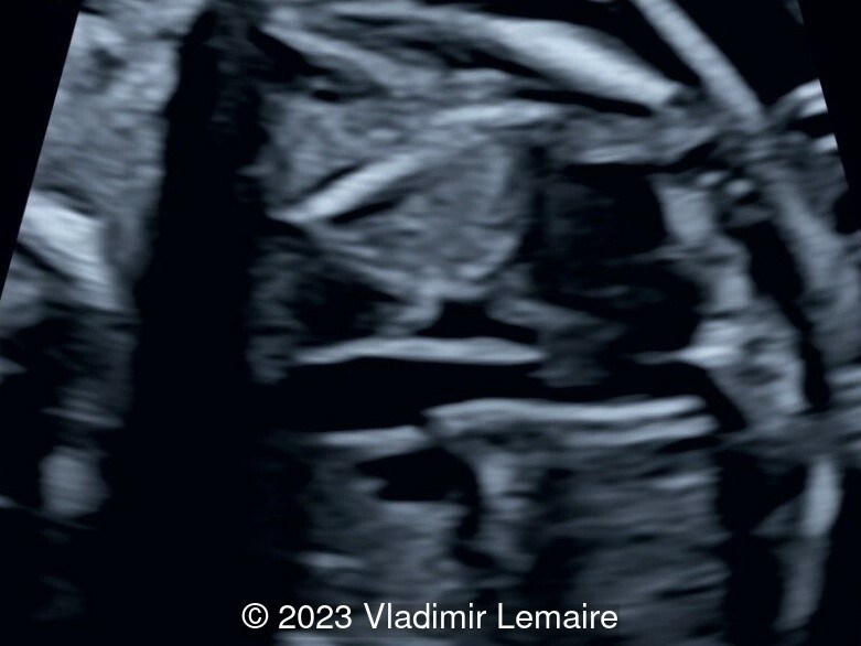 The right ventricular outflow tract shows three vessels in an abnormal configuration. The LSVC, the pulmonary artery, and the ascending aorta are seen from left to right.