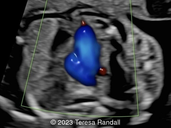 Corresponding ultrasound image at 22 weeks of gestation.