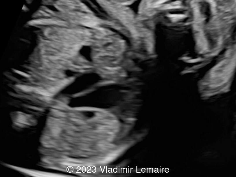 Corresponding ultrasound image of a fetus with bilateral superior vena cava.