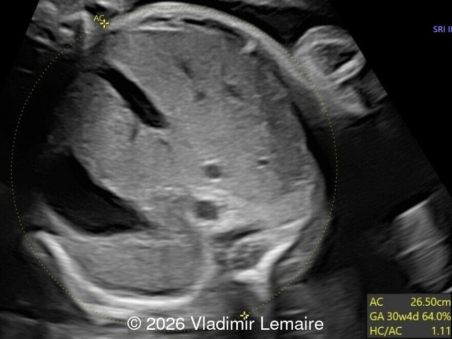Transverse view of the upper abdomen at the level of the abdominal circumference.