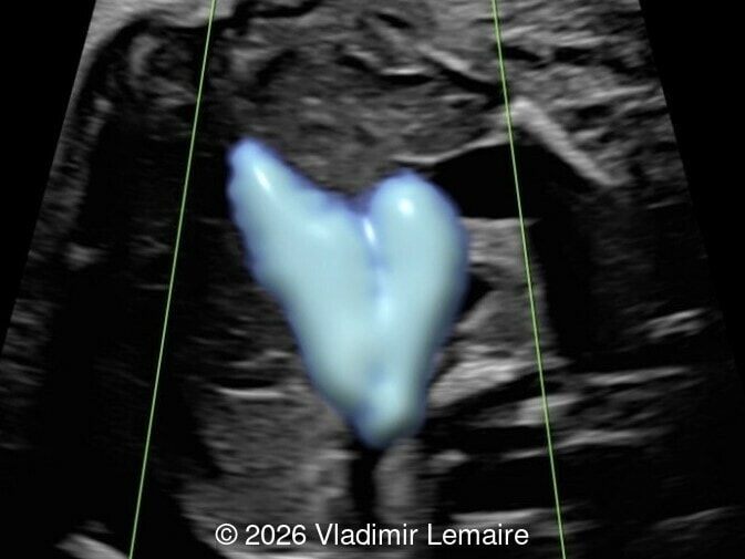 The three-vessel-trachea view with color Doppler.