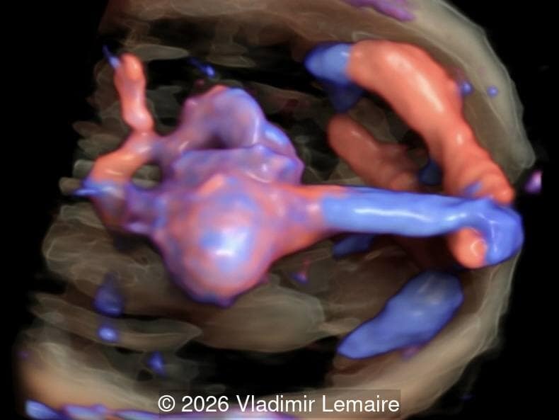  Axial 3D glass-body mode of the intracerebral vasculature.