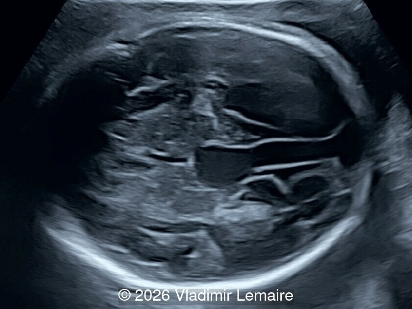 Axial image of the fetal head