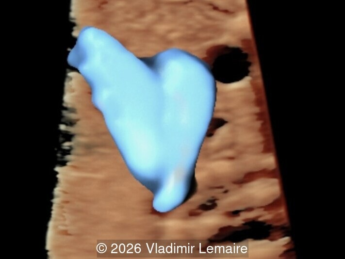 3D glass-body mode at the level of the three-vessel-trachea view. Note the dilation of the superior vena cava.