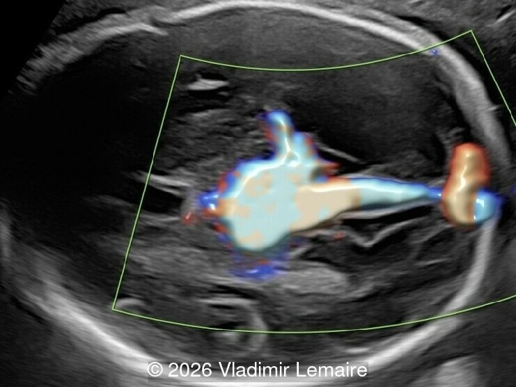 Axial image of the fetal head with high-definition color Doppler 