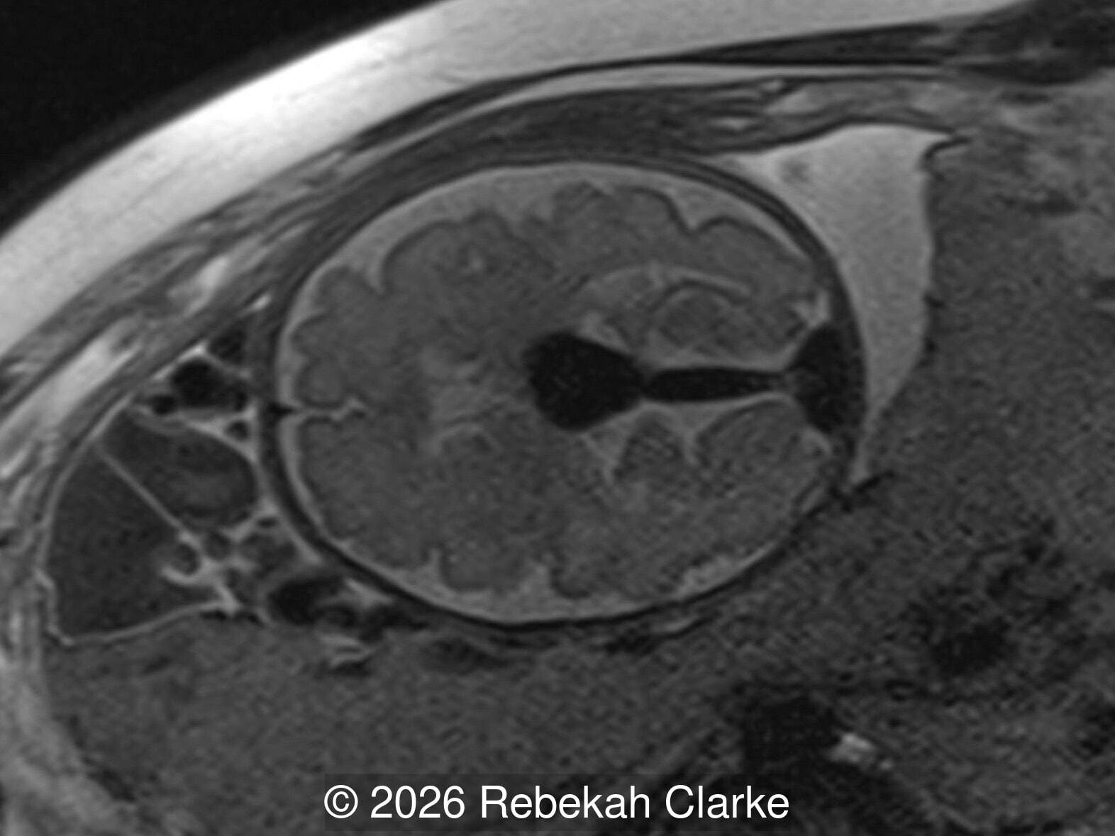Axial T2-weighted image through the fetal brain at the level of the cavum septum pellucidum, showing the prominent T2 hypointense flow void of the vein of Galen malformation.