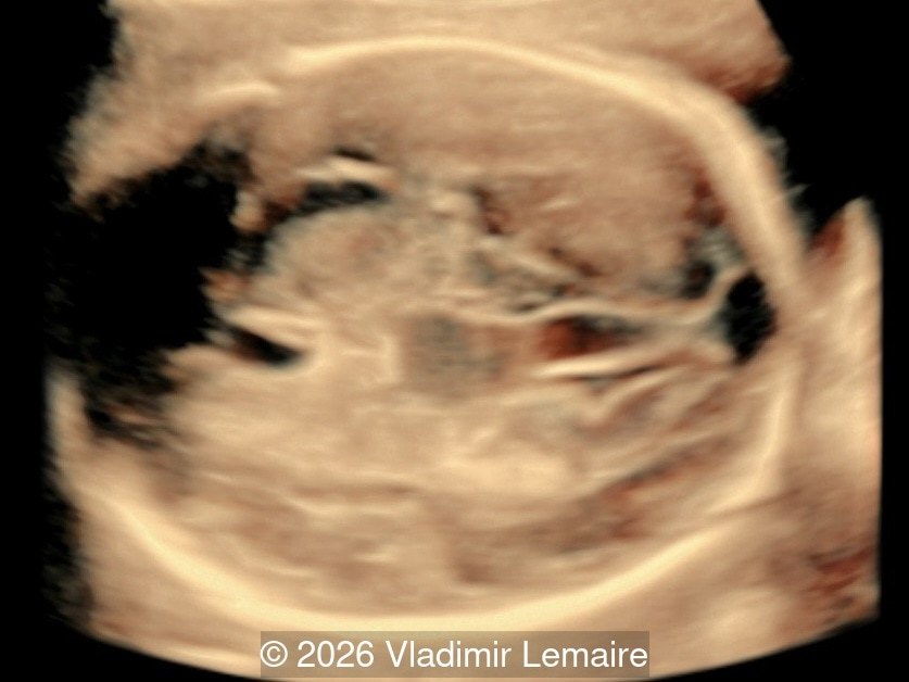 Surface mode rendering looking into the brain of the same fetus with the vein of Galen aneurysmal malformation.