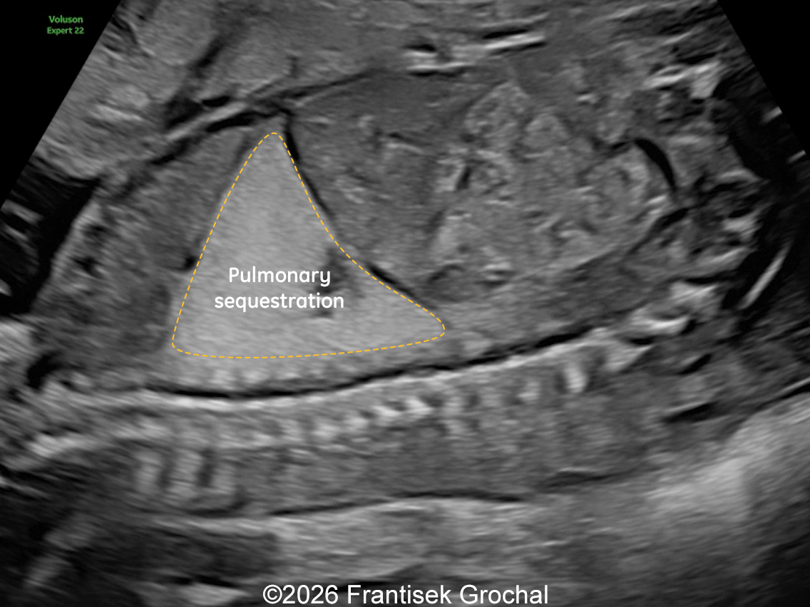 22+3 weeks of gestation &ndash; sagittal view demonstrating a well-circumscribed, triangular pulmonary sequestration.