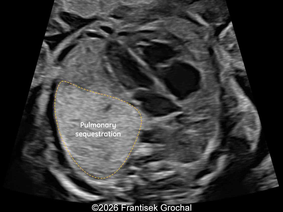 22+3 weeks of gestation &ndash; transverse thoracic view at the level of the four-chamber cardiac view demonstrating a well-circumscribed hyperechoic pulmonary sequestration. The heart is displaced to the right.