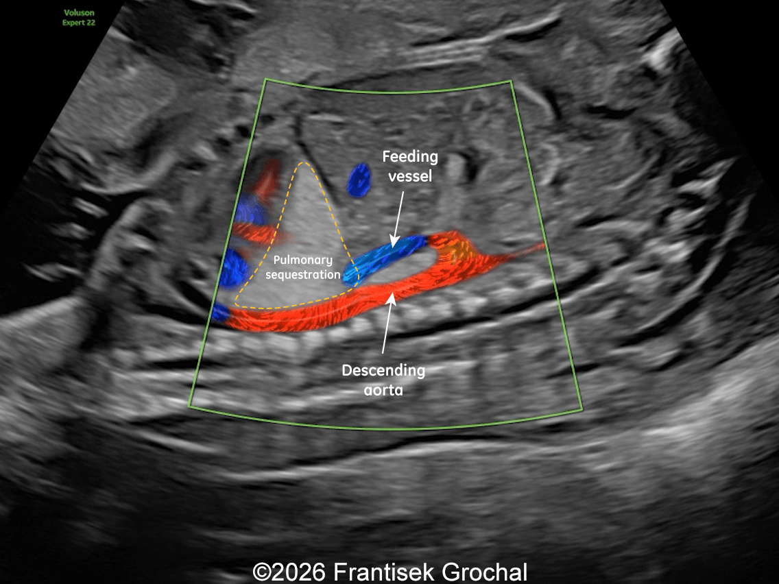 22+3 weeks of gestation &ndash; sagittal view demonstrating a well-circumscribed, triangular pulmonary sequestration; color Doppler imaging demonstrates a systemic feeding artery arising from the descending abdominal aorta.