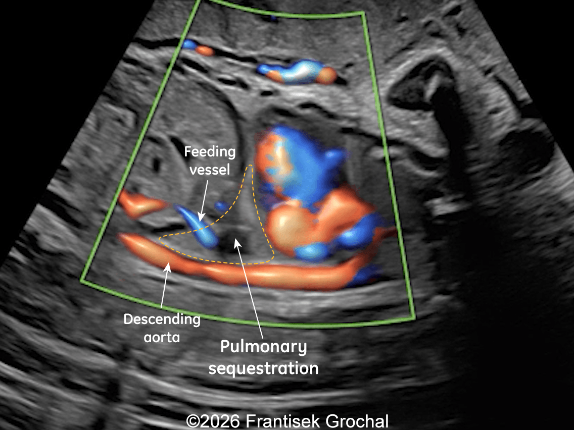 31+4 weeks &ndash; sagittal view demonstrating reduced size of the pulmonary sequestration with a small hypoechoic area within the lesion; color Doppler imaging still demonstrates a systemic feeding artery arising from the descending abdominal aorta.