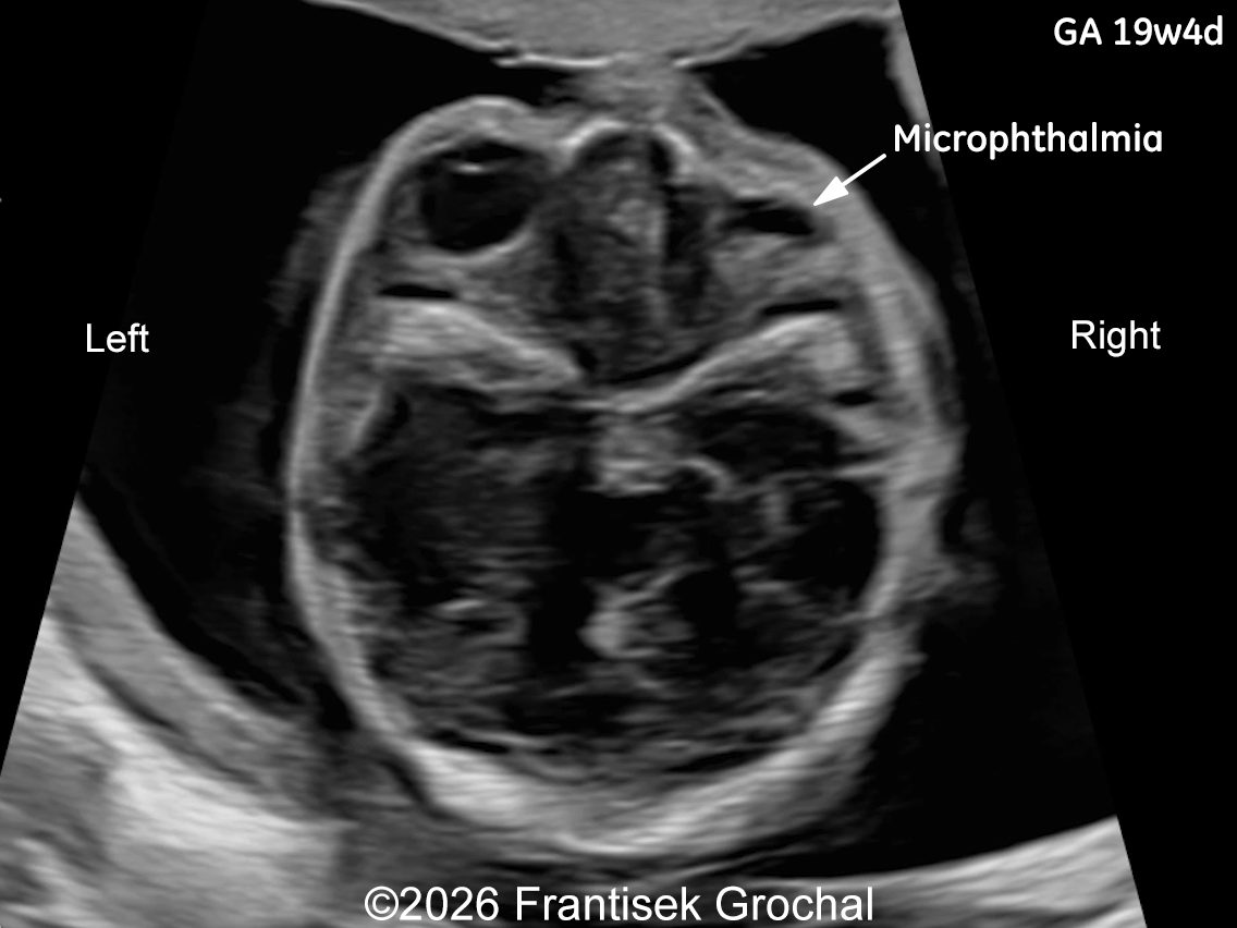 19+4 weeks of gestation; transverse view through the fetal orbits demonstrating right-sided microphthalmia.