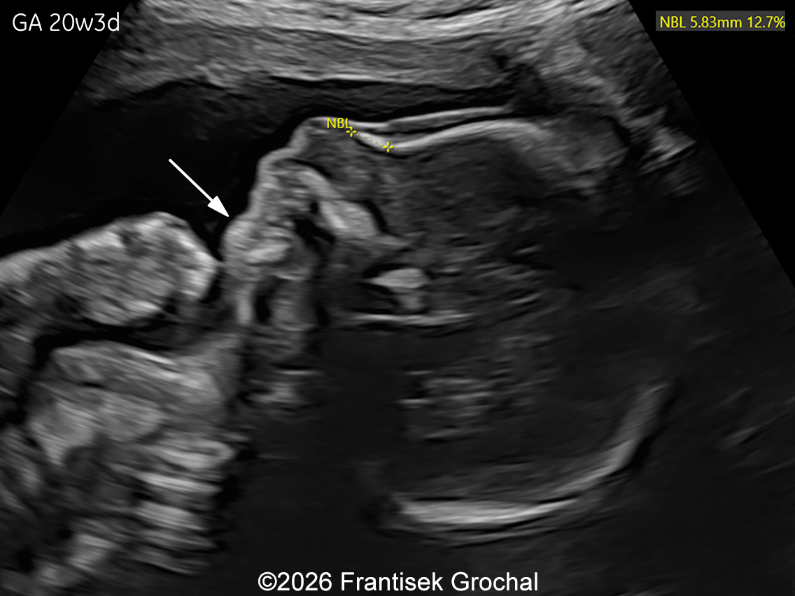 At 20w gestation, micrognathia is demonstrated (arrow).