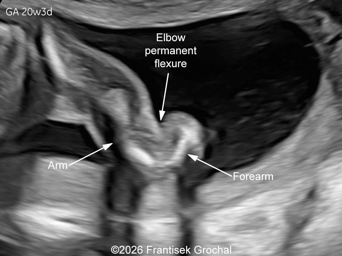 At 20w gestation, fixed flexion contractures of the elbows are observed.
